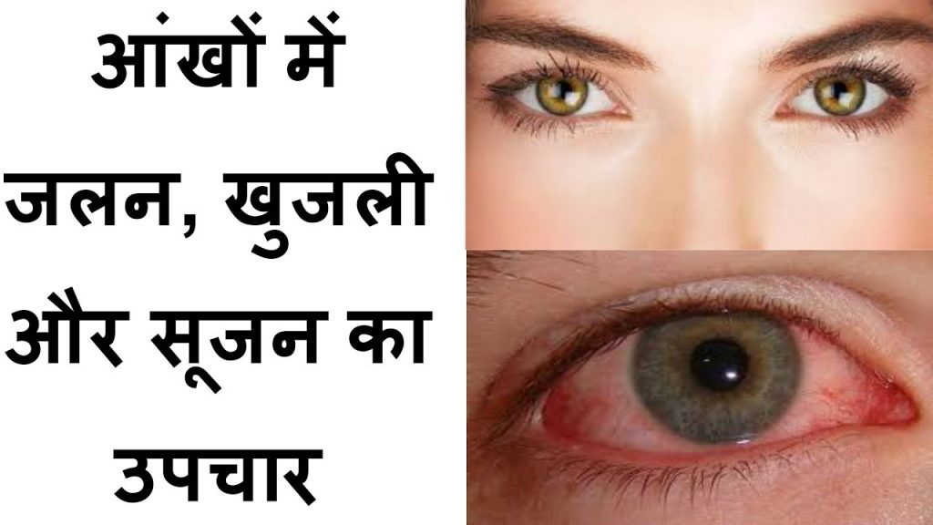 आँखों में जलन होना, क्यों होती हैआँखों में जलन, जलन के कारण और उपाय